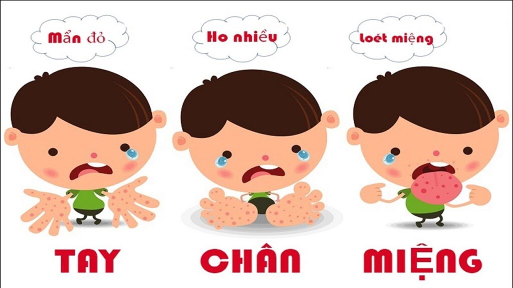 Tăng cường các biện pháp phòng bệnh tay chân miệng